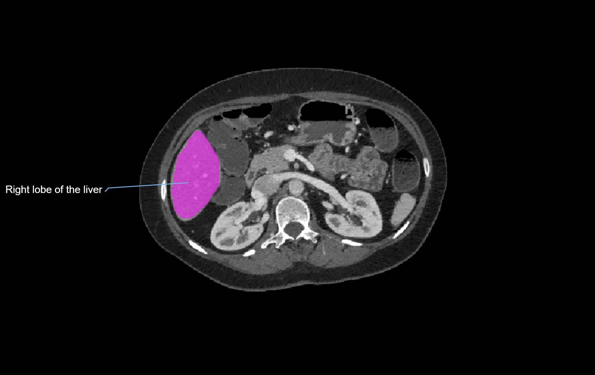 CT lliver lobes axial cross sectional anatomy labelled image -00028.webp